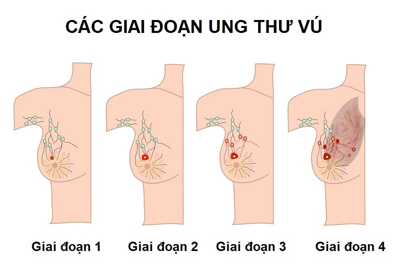 Ung thư vú cũng được chia thành nhiều giai đoạn khác nhau