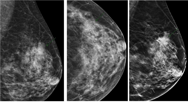 Hình ảnh trả về từ chụp X quang vú