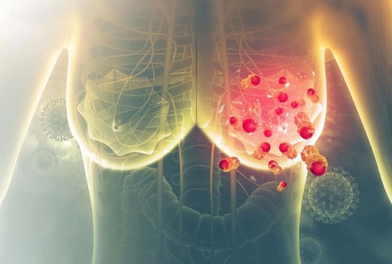 Ung thư vú có điều trị khỏi hay không còn phụ thuộc vào nhiều yếu tố