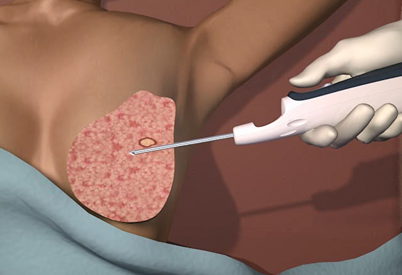 Mô phỏng kỹ thuật sinh thiết