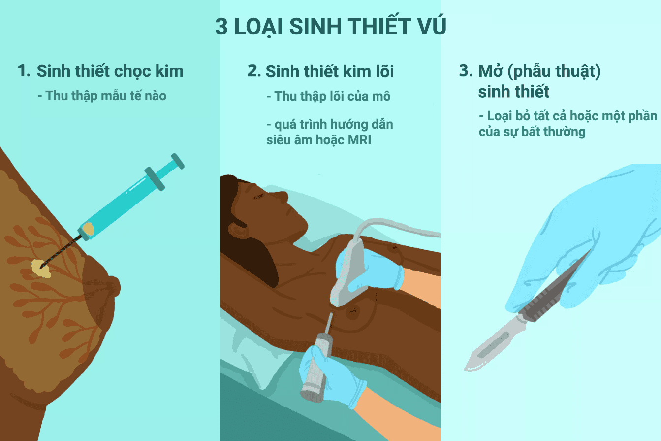 Sinh thiết vú có đau không? Tìm hiểu quy trình và cảm giác khi thực hiện